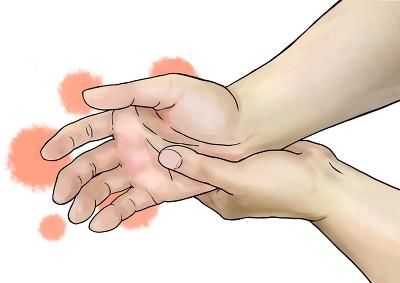 말초신경병증 치료