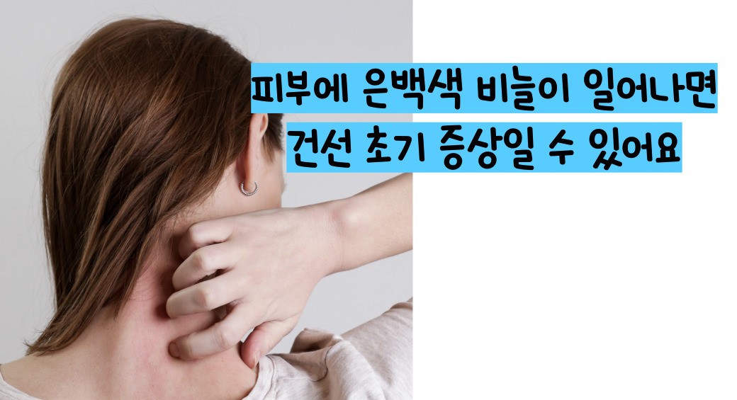 피부 건선 증상