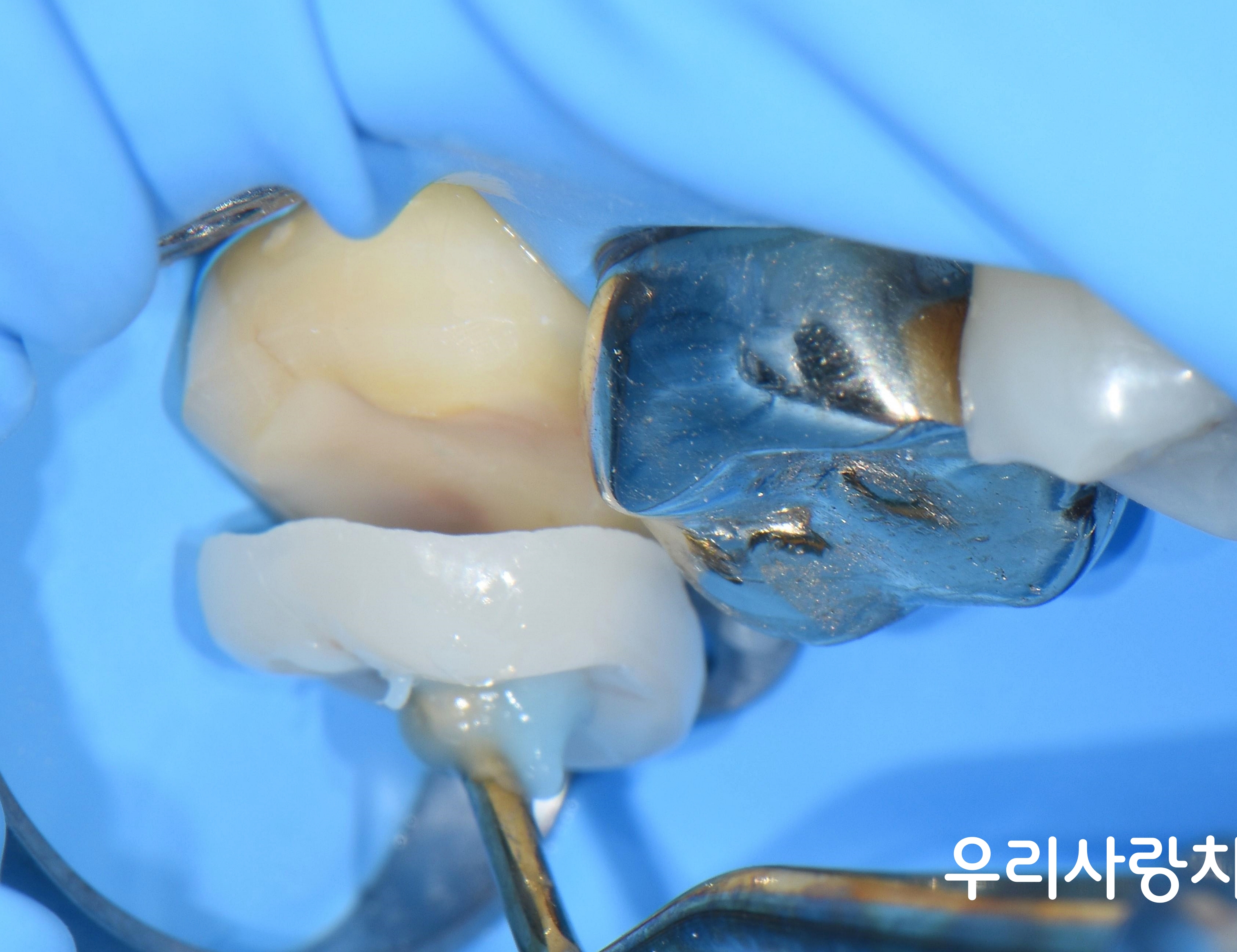 치아 전면 삭제(크라운)를 피하고 교합면만 덮는 오버레이(Overlay) 보철물 접착 과정