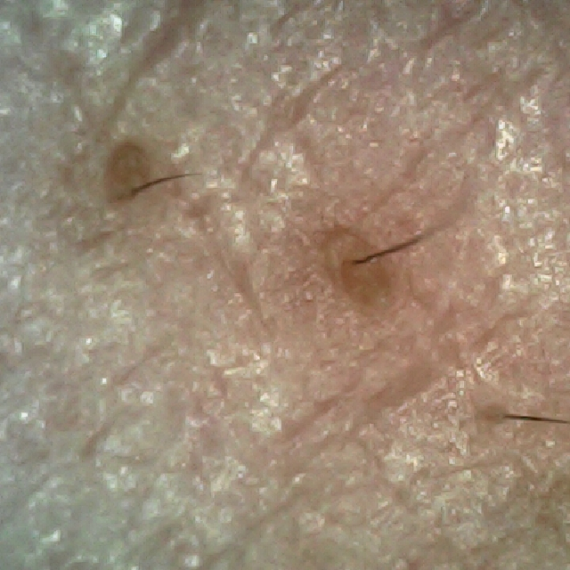 탈모 극복 프로젝트 - 오른쪽 M자 부위 두피 모습이다.