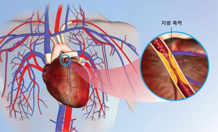 협심증 예방방법 협심증 약물치료 협심증 약물복용 협심증 약물 협심증 수술방법 협심증 수술 협심증 수술치료 협심증 예방 