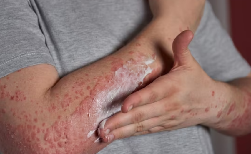 모공각화증의 증상