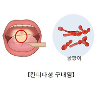 구내염 원인