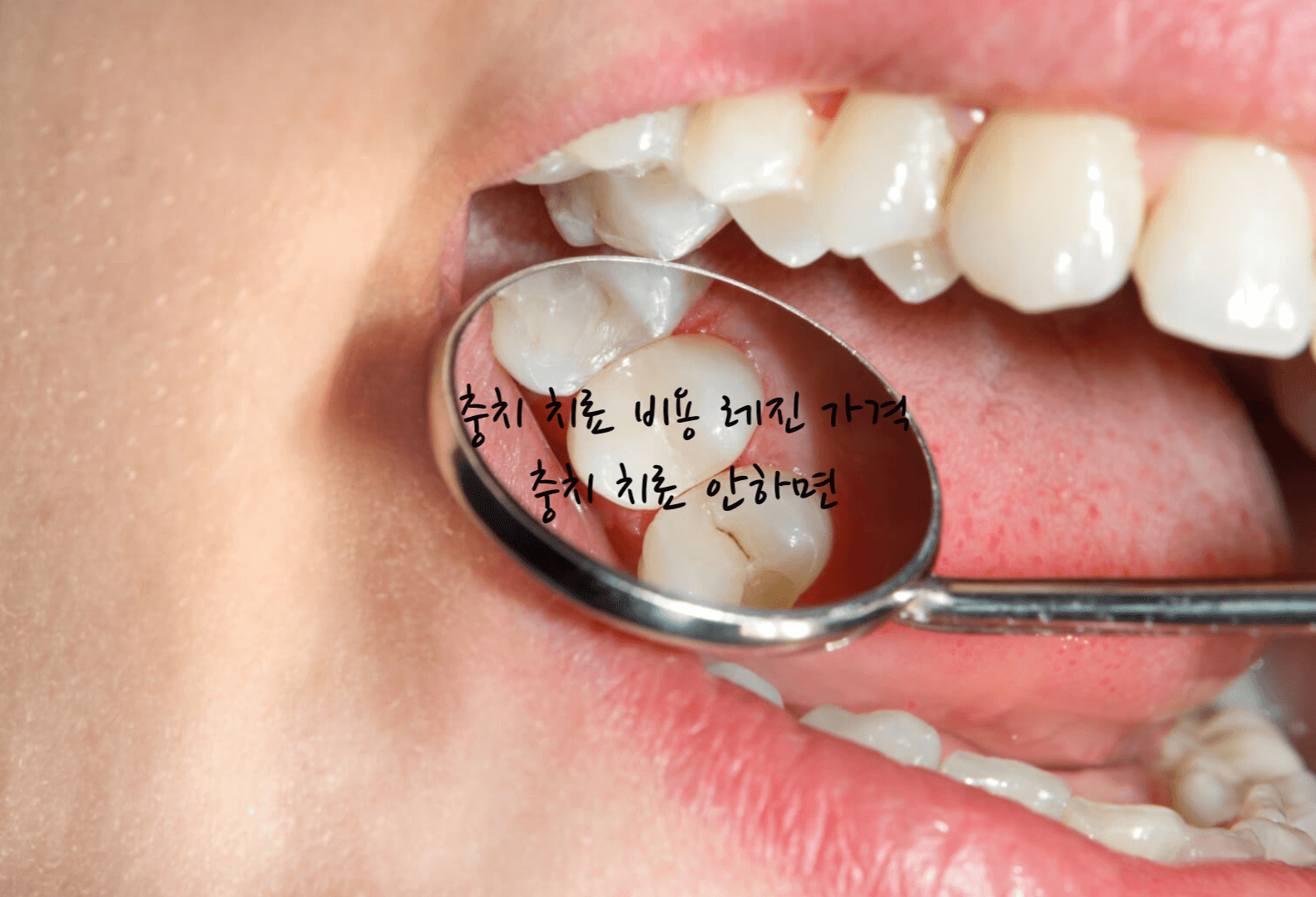 충치 치료 비용