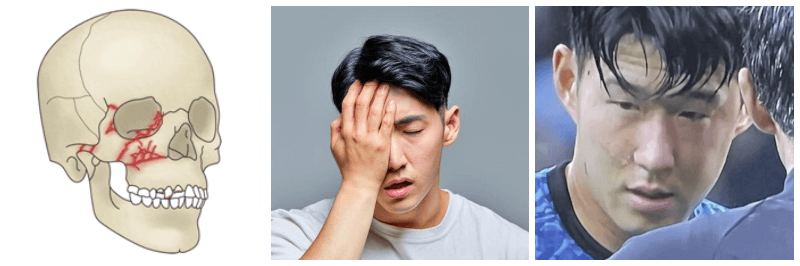안와골절 사진 3개