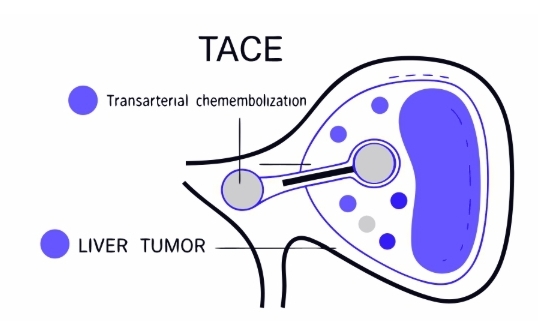 간암 치료 과정