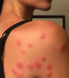 빈대 물린 자국 2