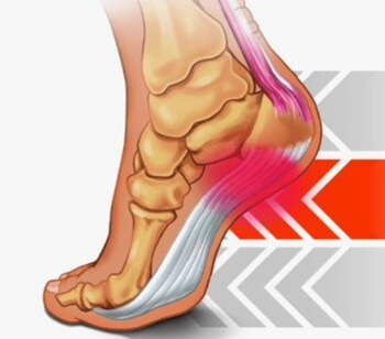 족저근막염 위치를 나타낸 발