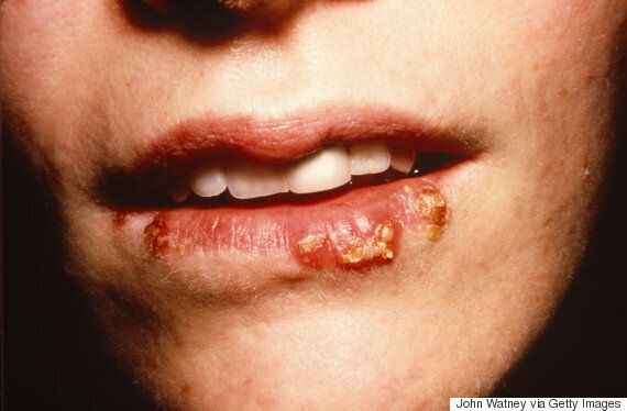 헤르페스 2형 1형 바이러스 치료법 증상 성병 연고 보균자