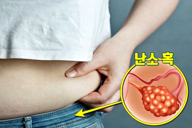 갑자기 뱃살이 찌는 이유 다낭성 난소증후군, 팔뚝살, 여자 뱃살, 남자 뱃살, 건강 다이어트 팁줌 매일꿀정보