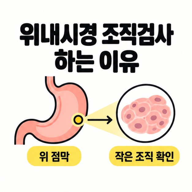 위내시경 조직검사 하는 이유라는 제목과 위 점막의 작은 조직을 확인하는 개념 도식