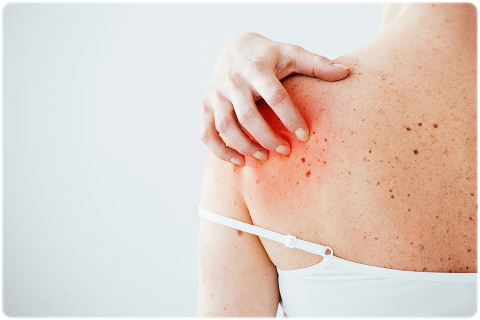 피부암 초기증상 원인 종류 진단 및 치료 방법 예방 방법