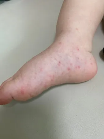 수족구 초기 증상 어른 감염 격리기간 예방 치료 완전 가이드_11