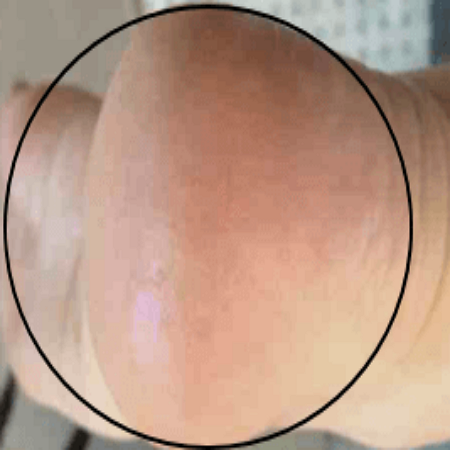 발각질 제거 후 모습