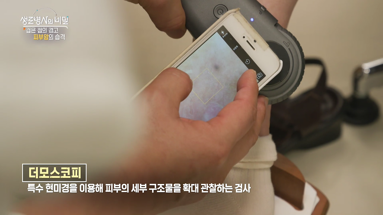생로병사의 비밀 피부암 검은점