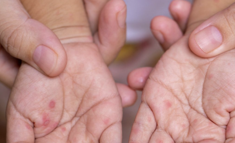 수족구 증상 12가지 총정리 섬네일