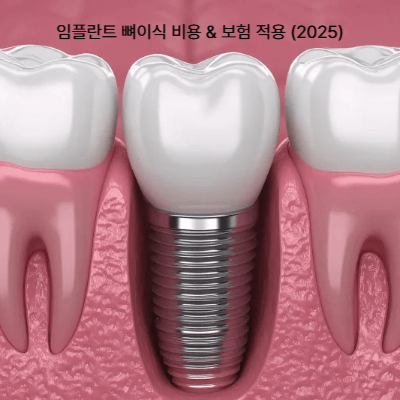 임플란트 뼈이식 비용 &amp; 보험 적용 (2025)