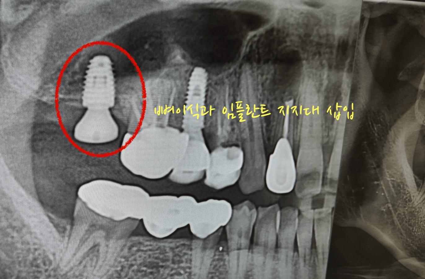 임플란트 삽입