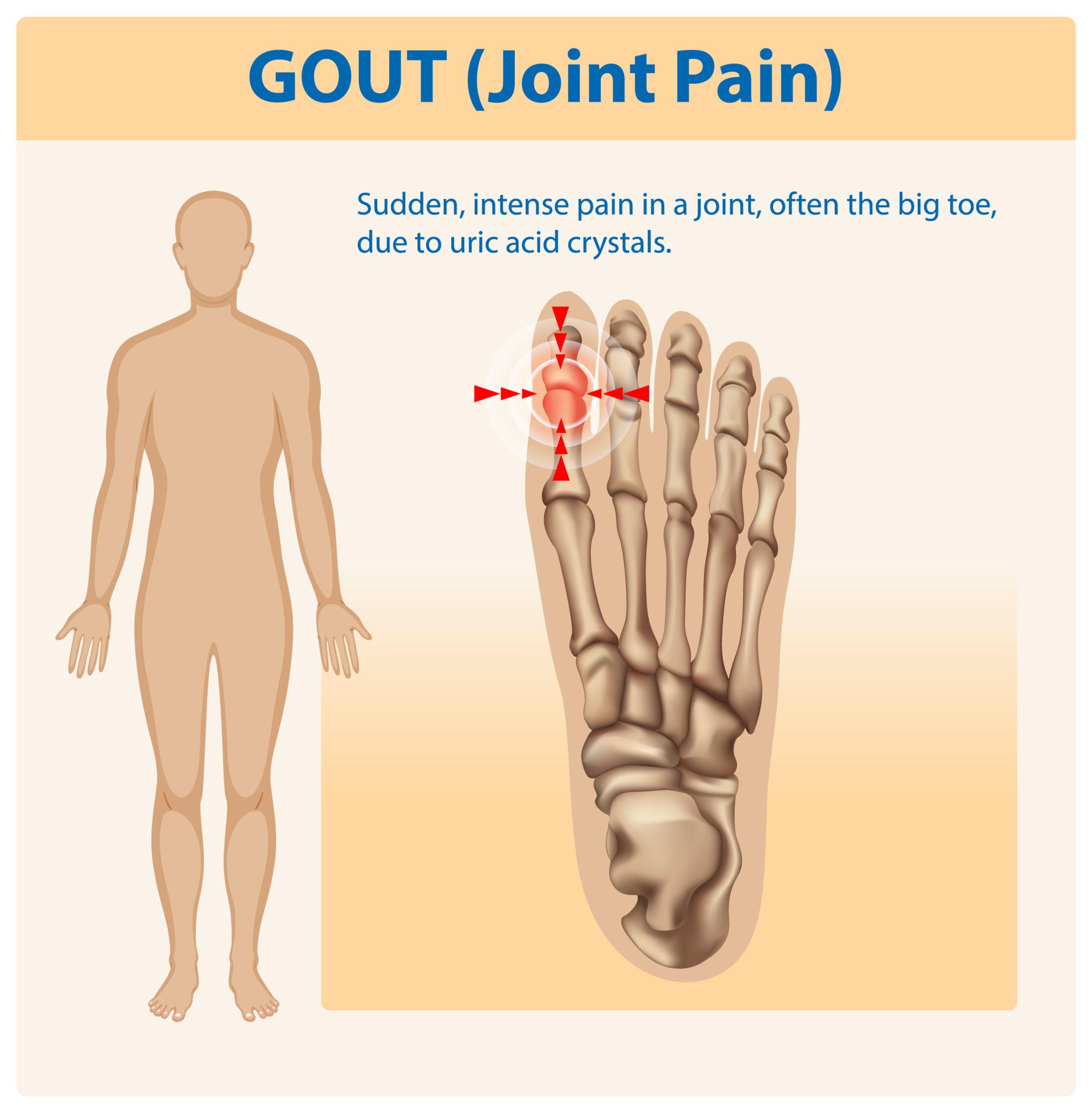 통풍 환자에게 좋은 또는 나쁜 음식 좋은 운동은 무엇인가요