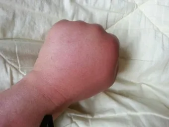 쇠파리에 물리면 증상 대처법과 응급처치 방법 안내_22