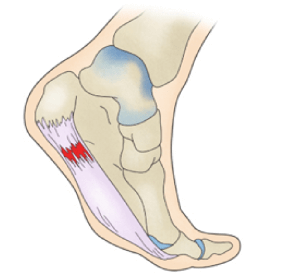 족저근막염-치료법