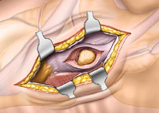 부주상골제거술-accessorynavicularsurgery