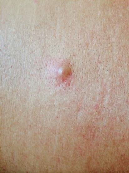 항문농양 진단 방법 &ndash; 조기 발견이 중요한 이유