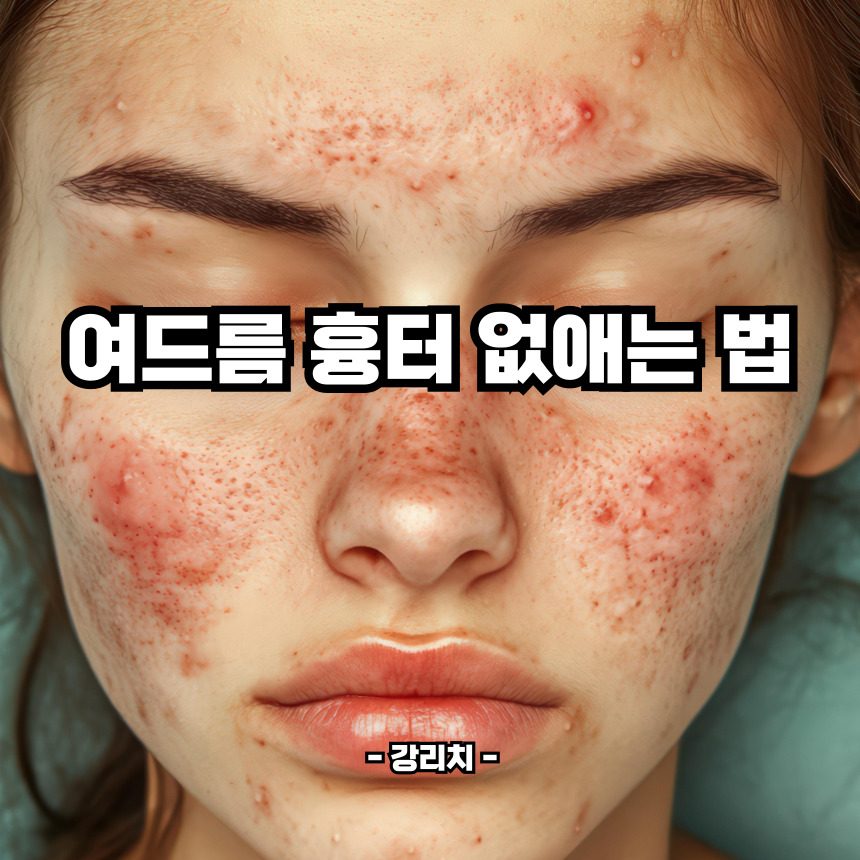여드름 흉터 없애는 법