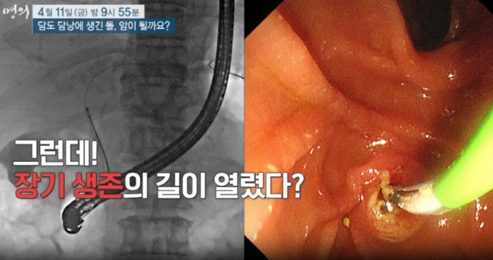 명의-담도-담낭암-진료-치료