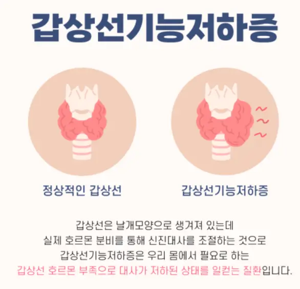 갑상선기증저하증