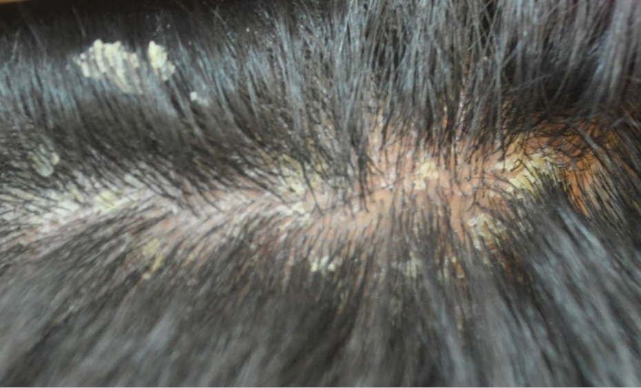 두피가려움증비듬