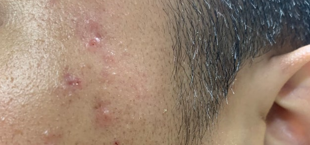 관자놀이 여드름1