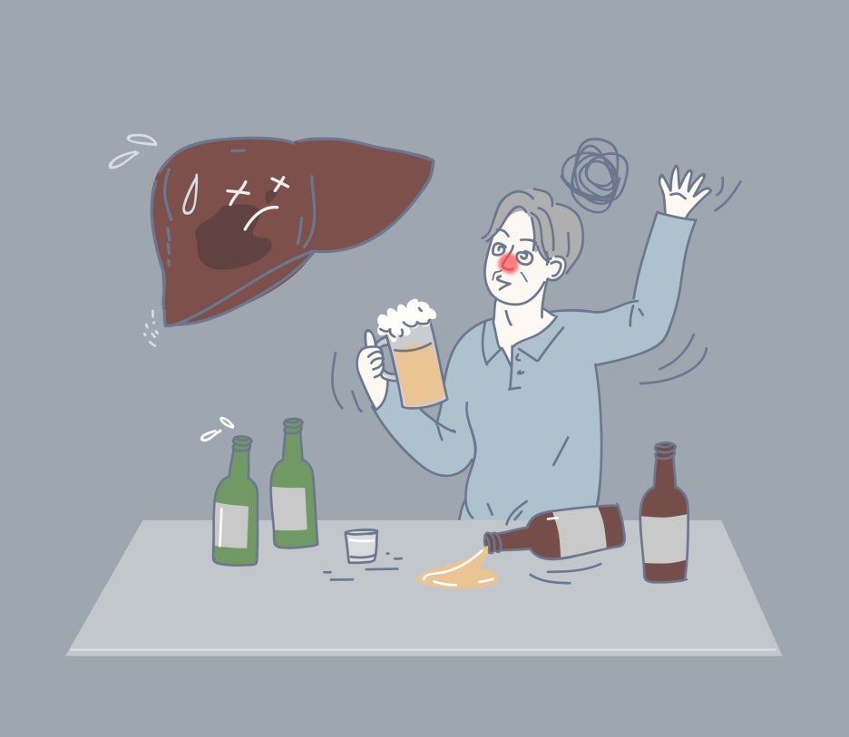 알코올성 간염 (Alcoholic Hepatitis)