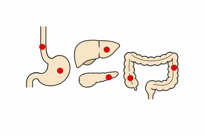 암환자 산정특례 제도