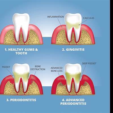 40대 치주질환이 전신건강에 미치는 영향