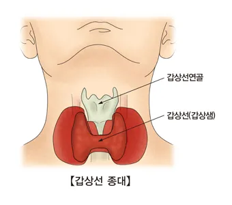 갑상선 기능 저하증 증상 6가지는 무엇인지 알아보기_5