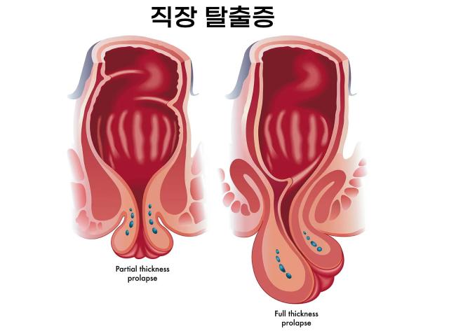 만성변비 합병증 직장탈출증