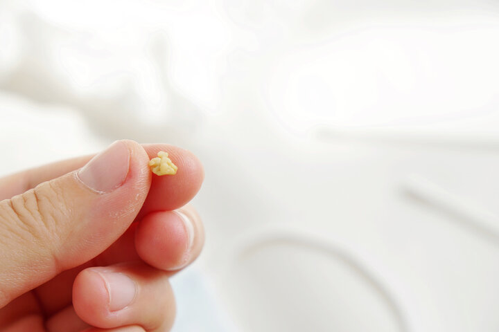 편도결석 원인, 증상 및 제거방법 총정리