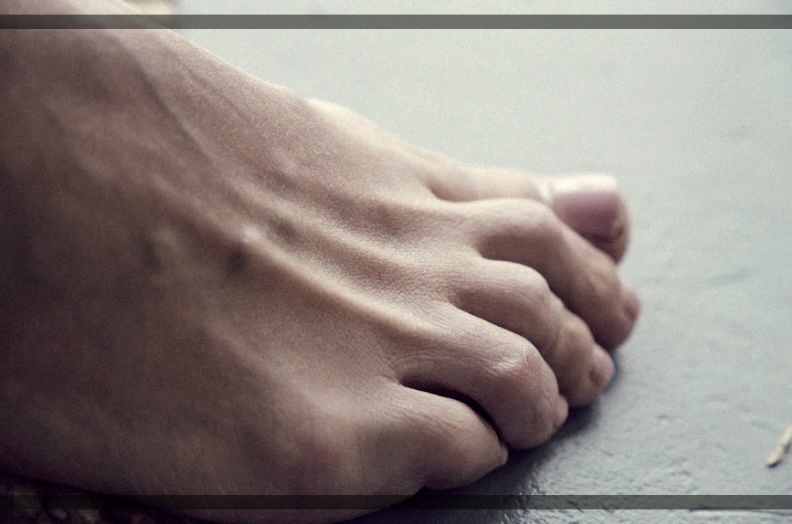 지간형 무좀 치료 방법의 장단점.