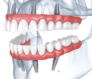 오스템 임플란트 가격, 종류