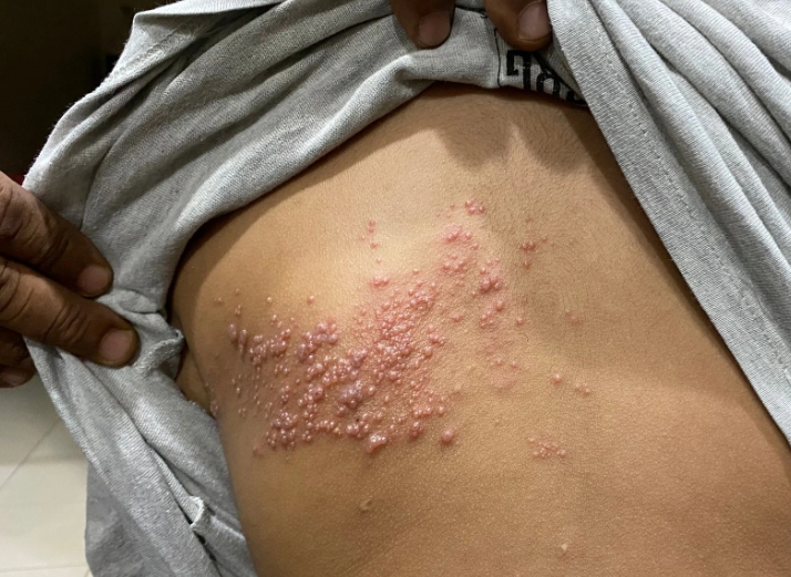 대상포진 치료법 (약물, 식이, 휴식)