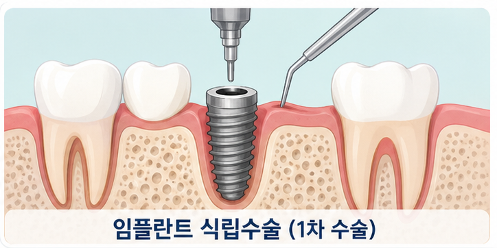 2 임플란트 식립수술 1차