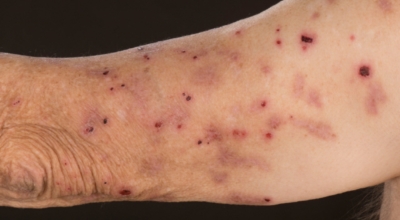 대상포진이미지