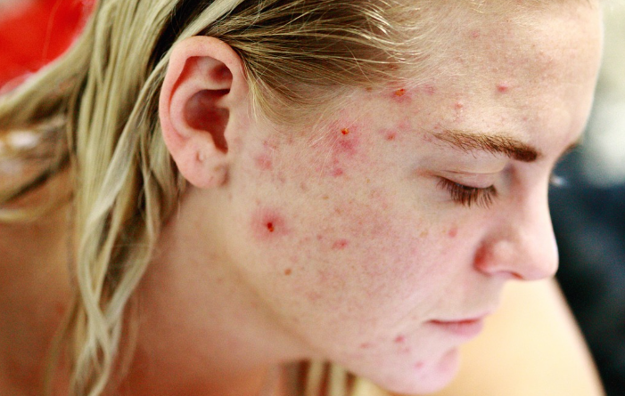 여드름 연고 완벽 정리: 피부과 전문가 추천과 올바른 사용법