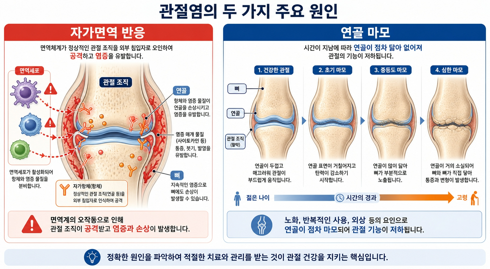 류마티스 관절염 원인 자가면역 골관절염 원인 연골 마모