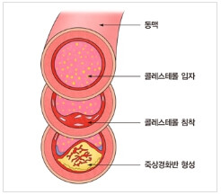 혈관내 콜레스테롤의 변화
