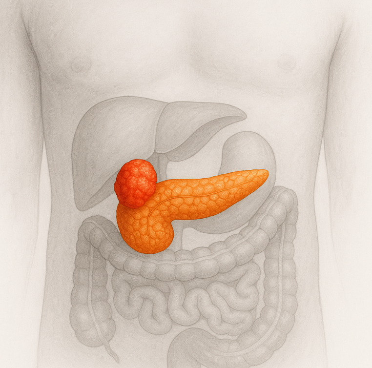 췌장암 말기4기마지막증상