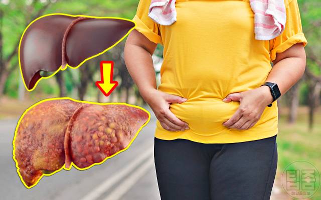 간암 원인 40대 50대 간암 예방법