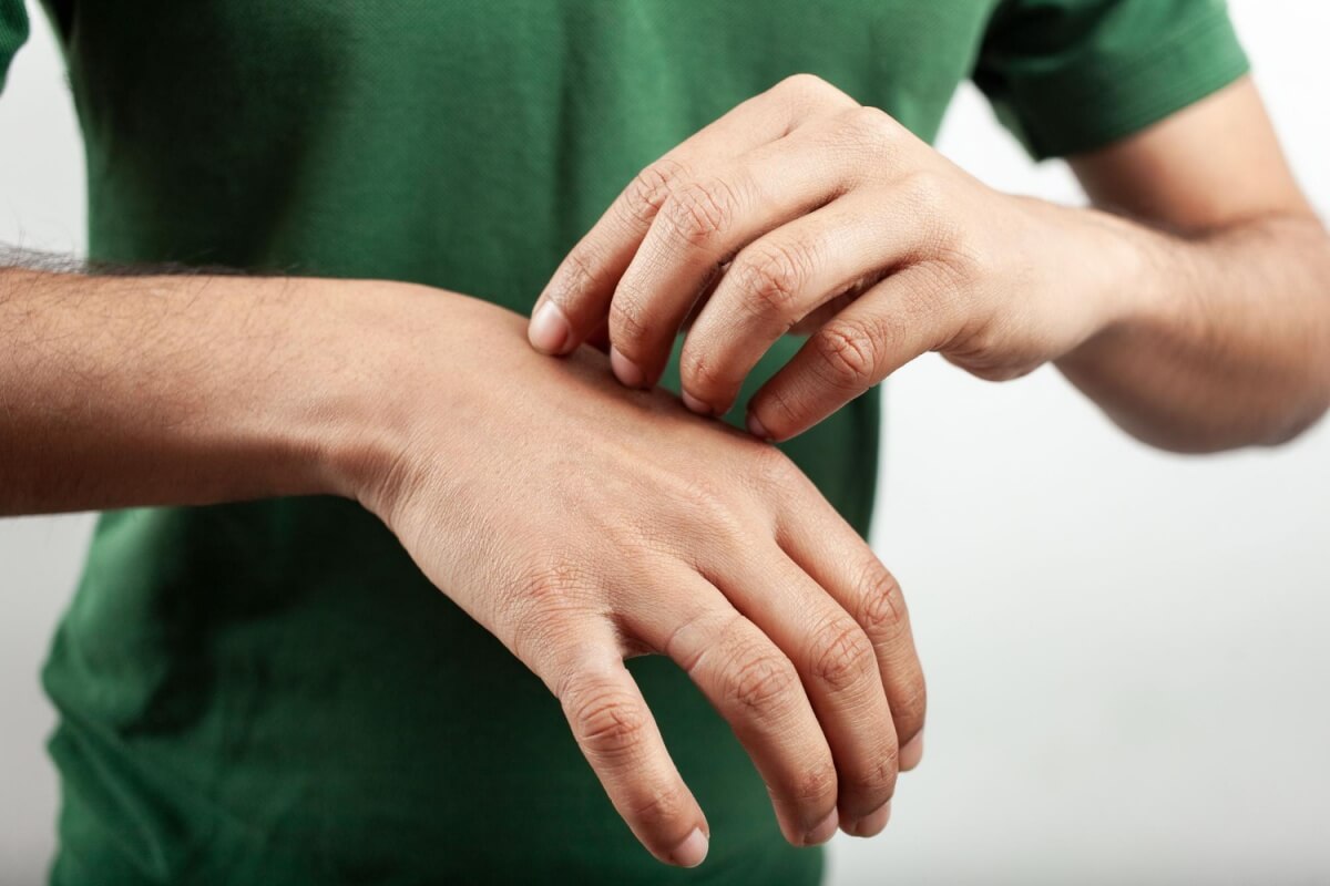 메스버그의-주요증상-가려움