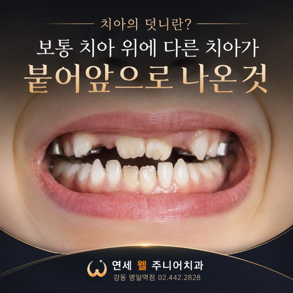 치아 뒤쪽이나 바깥쪽으로 다른 치아가 겹쳐 나오는 초등학생 덧니 모습